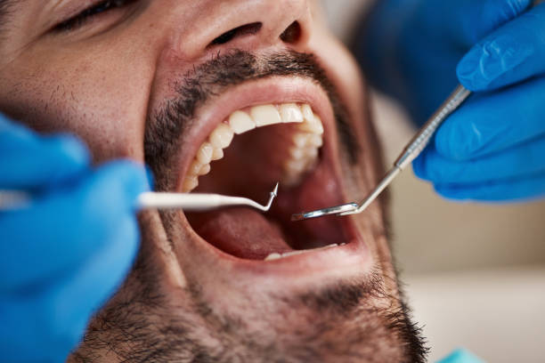 Best Dentist for Tooth Abscess  in Kingsland, TX